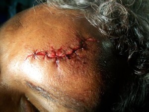scalp laceration after a fall