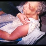 elder abuse, bruises on elderly woman