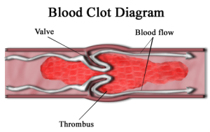deep vein thrombosis