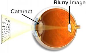 diagram of cataract